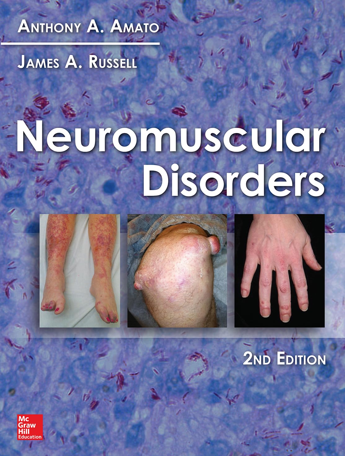 Neuromuscular Disorders, 2nd Edition 2nd Edition