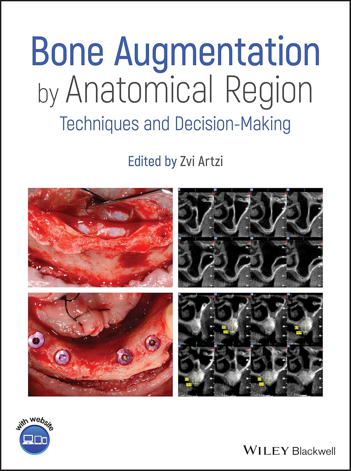 Bone Augmentation by Anatomical Region: Techniques and Decision-Making 1st Edition