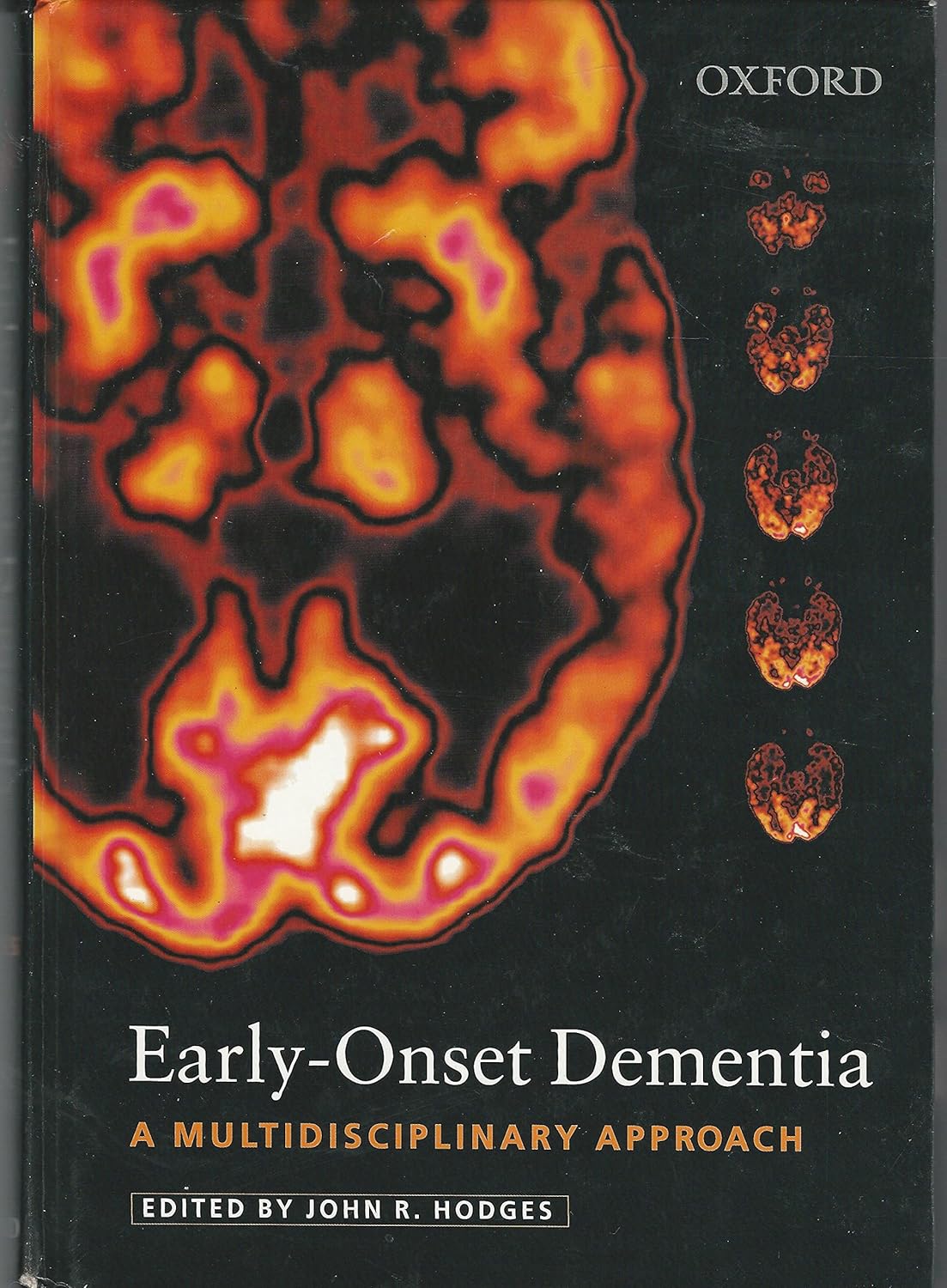 Early-Onset Dementia A Multidisciplinary Approach