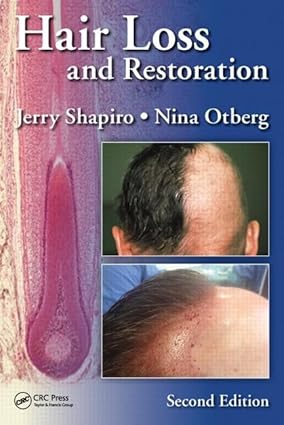 Hair Loss and Restoration 2nd Edition