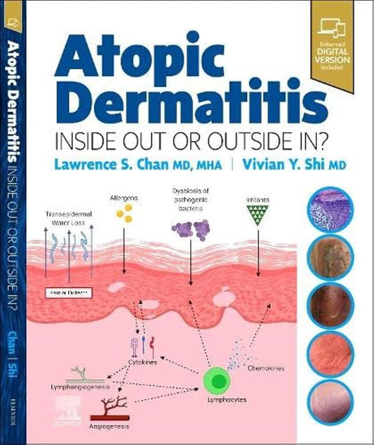 Atopic Dermatitis: Inside Out or Outside In, 1st Edition